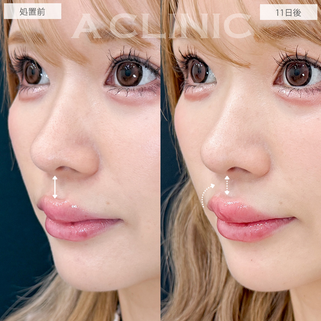 切らない人中短縮なら傷跡ナシで人中を短く見せられます！こちら処置前と11日後の症例です(30代女性)