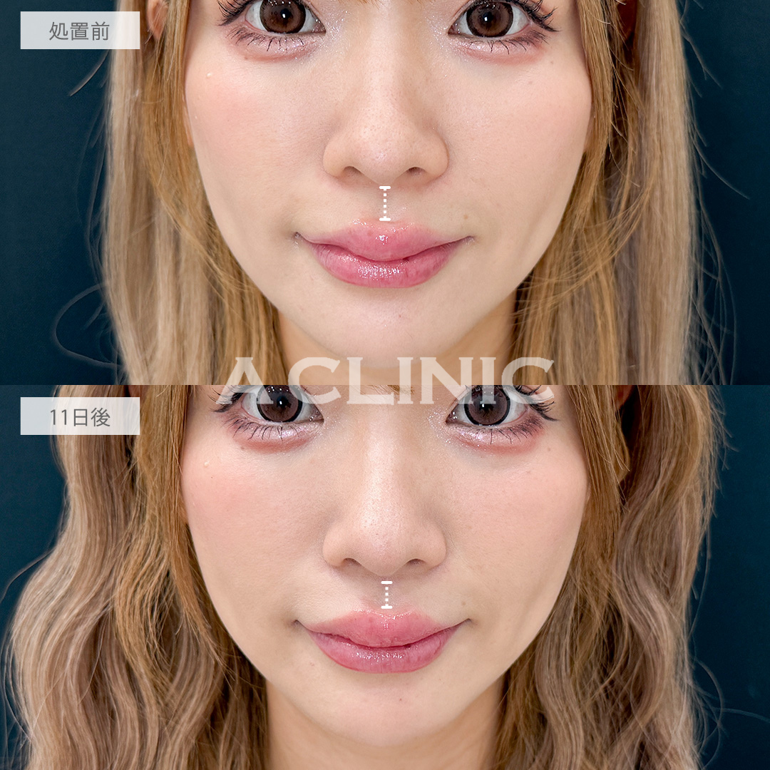 切らない人中短縮なら傷跡ナシで人中を短く見せられます！こちら処置前と11日後の症例です(30代女性)