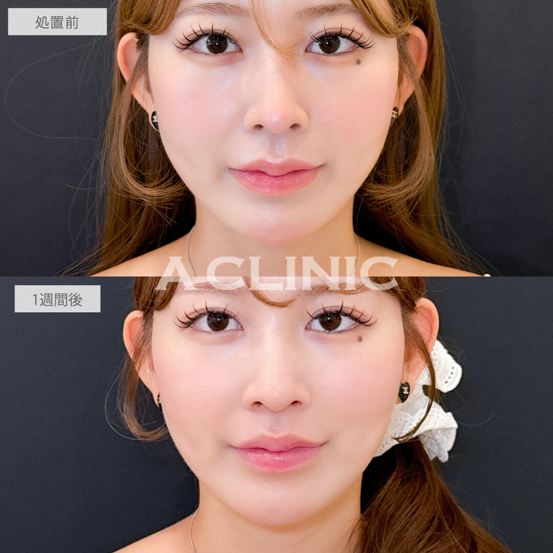 切らない人中短縮(Cカール形成術)とボトックス注射(しわ)で美人顔の黄金比率を叶えました！こちら処置前と1週間後の症例です(20代女性)