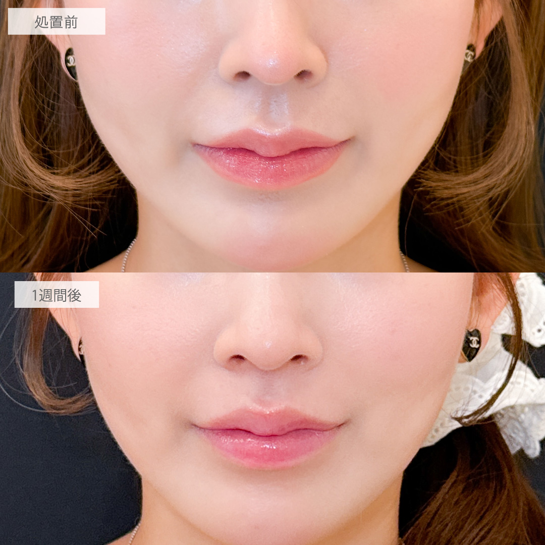 切らない人中短縮(Cカール形成術)とボトックス注射(しわ)で美人顔の黄金比率を叶えました！こちら処置前と1週間後の症例です(20代女性)