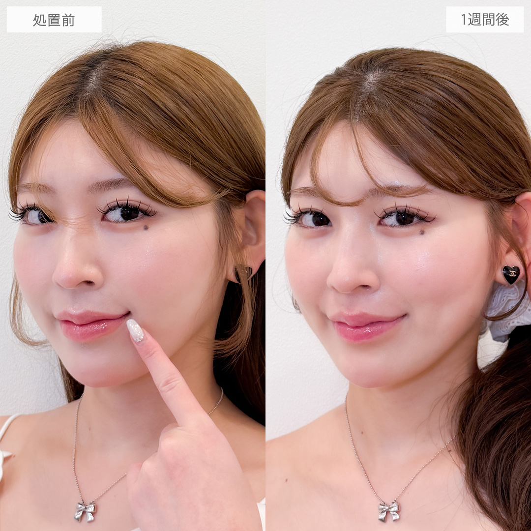 切らない人中短縮(Cカール形成術)とボトックス注射(しわ)で美人顔の黄金比率を叶えました！こちら処置前と1週間後の症例です(20代女性)