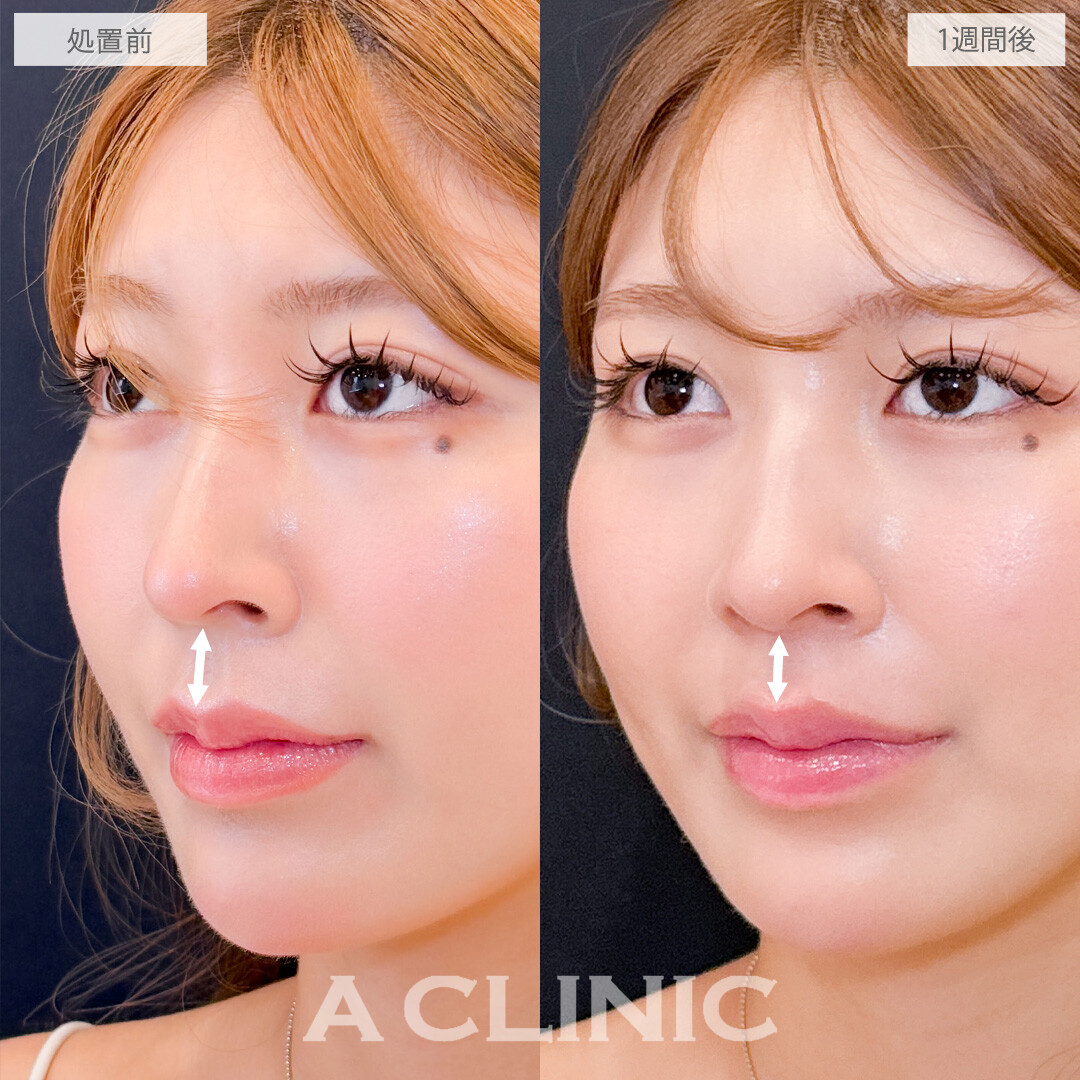 切らない人中短縮(Cカール形成術)とボトックス注射(しわ)で美人顔の黄金比率を叶えました！こちら処置前と1週間後の症例です(20代女性)