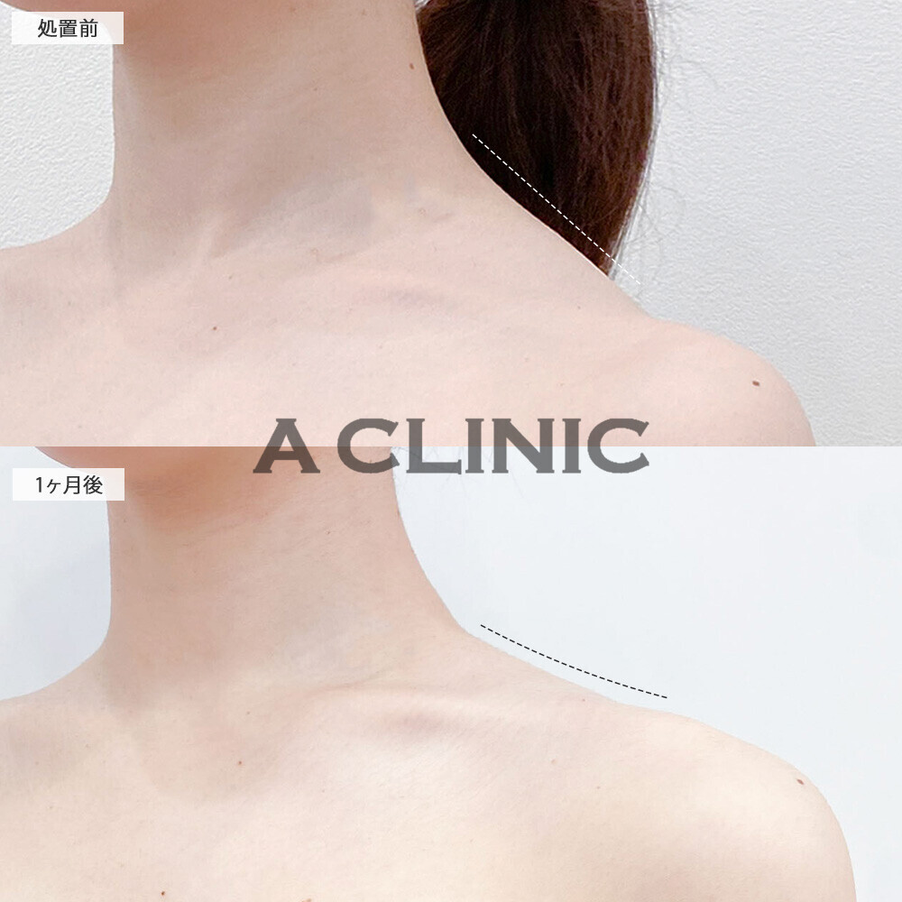 ボトックス注射(肩)で筋肉の張りが無くなり華奢な印象に！こちら処置前と1ヶ月後の症例です(20代女性)