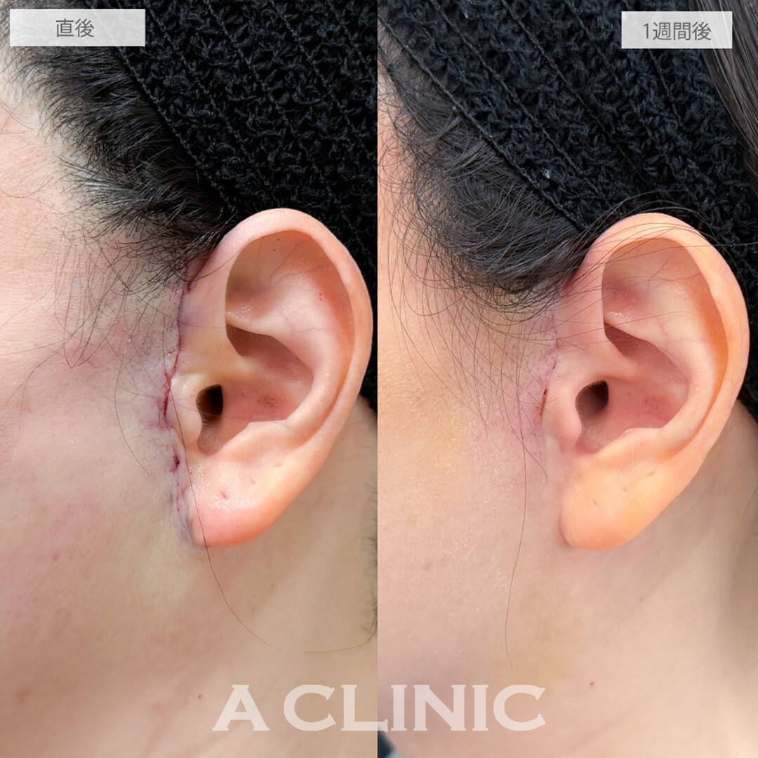 【直後の傷跡あり】A式美肌たるみ切開と小顔エラボトックスとヒアルロン酸注射(シワ)でほうれい線がなくなり若返り成功！処置前と1週間後の症例です(40代女性)