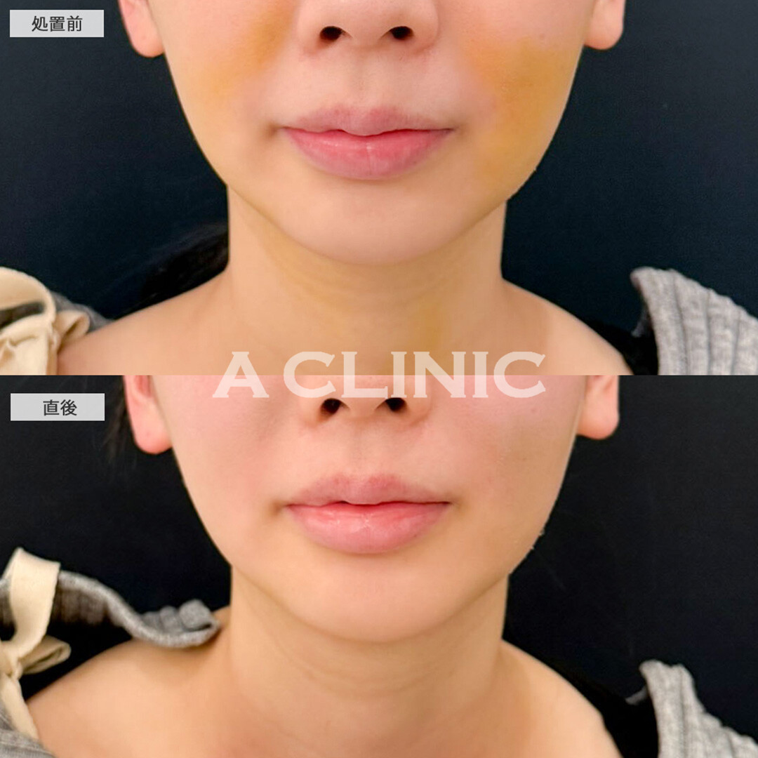 KOライトで直後から内出血が軽減！こちら処置前と直後の症例です(20代女性)