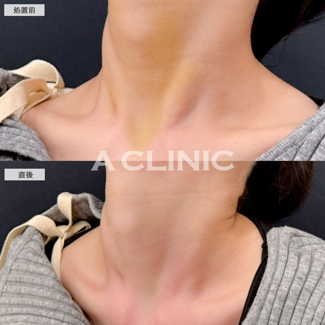 KOライトで直後から内出血が軽減！こちら処置前と直後の症例です(20代女性)