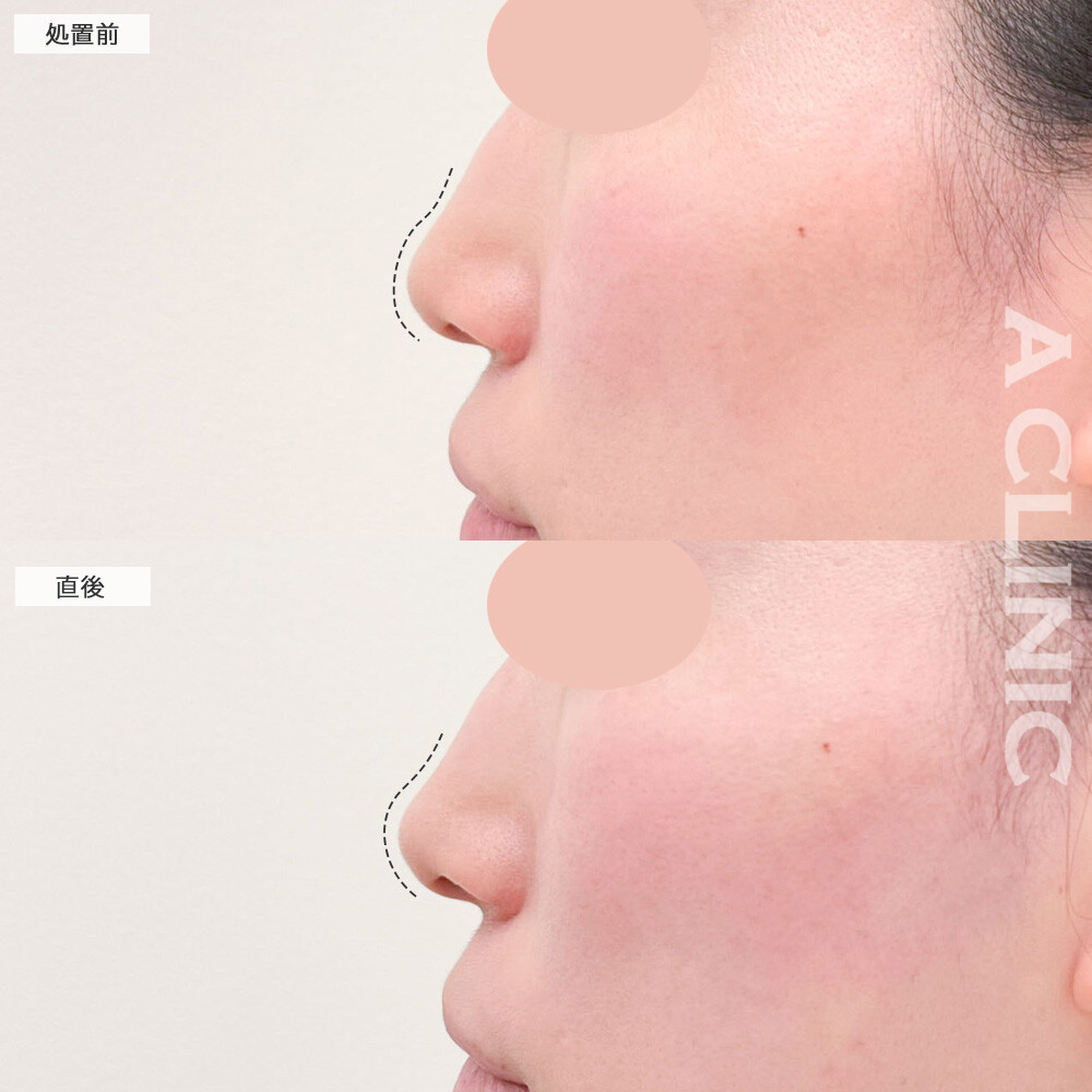 コリアンノーズで鼻先を高く見せます！こちら処置前と直後の症例です(30代女性)
