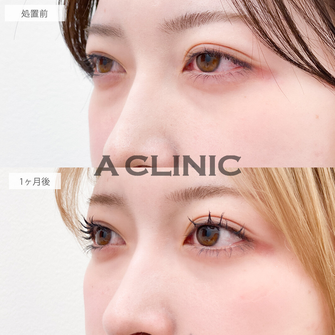 目の下のクマ取りで気になる黒クマをメイクで隠さなくてよくなります！こちら処置前と1ヶ月後の症例です(10代女性)