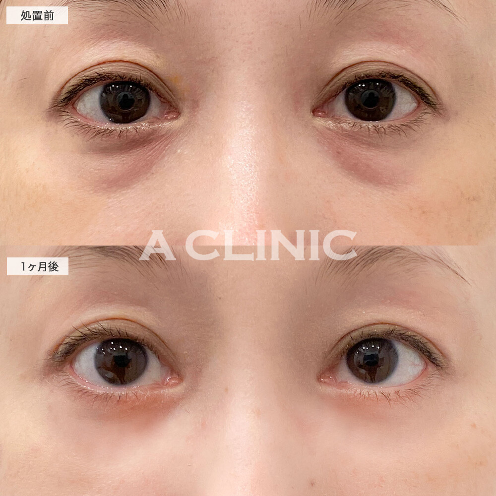 目の下のふくらみ取りで化粧で隠せなかったクマとお別れ！こちら処置前と1ヶ月後の症例です(40代女性)