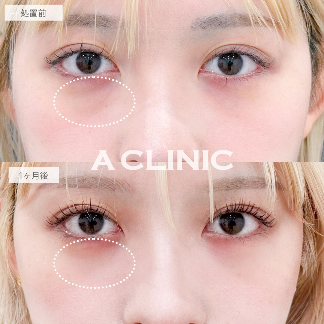 目の下のクマ取りで目元の影がなくなって一気に明るい印象に！こちら処置前と1か月後の症例です(20代女性)