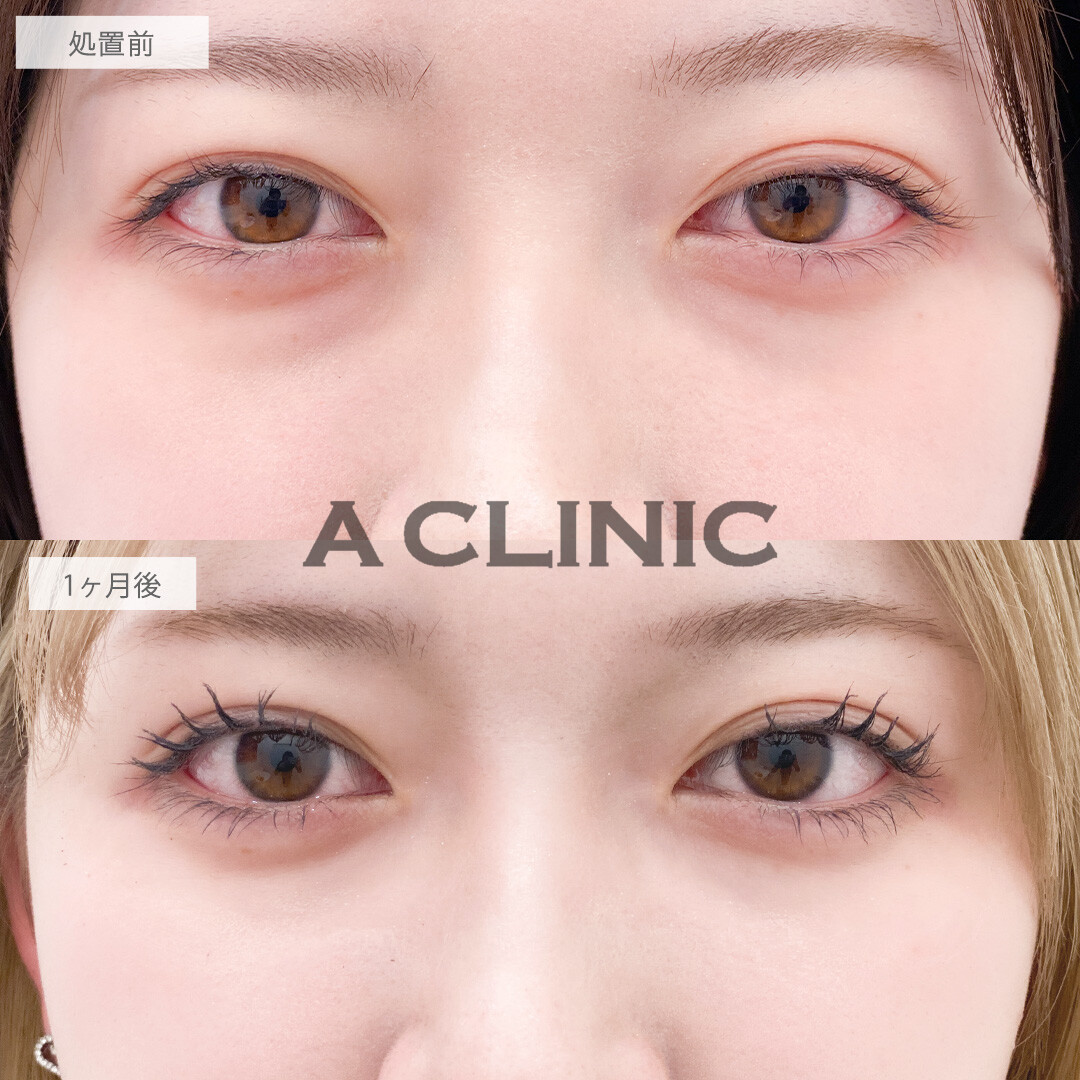 目の下のクマ取りで気になる黒クマをメイクで隠さなくてよくなります！こちら処置前と1ヶ月後の症例です(10代女性)