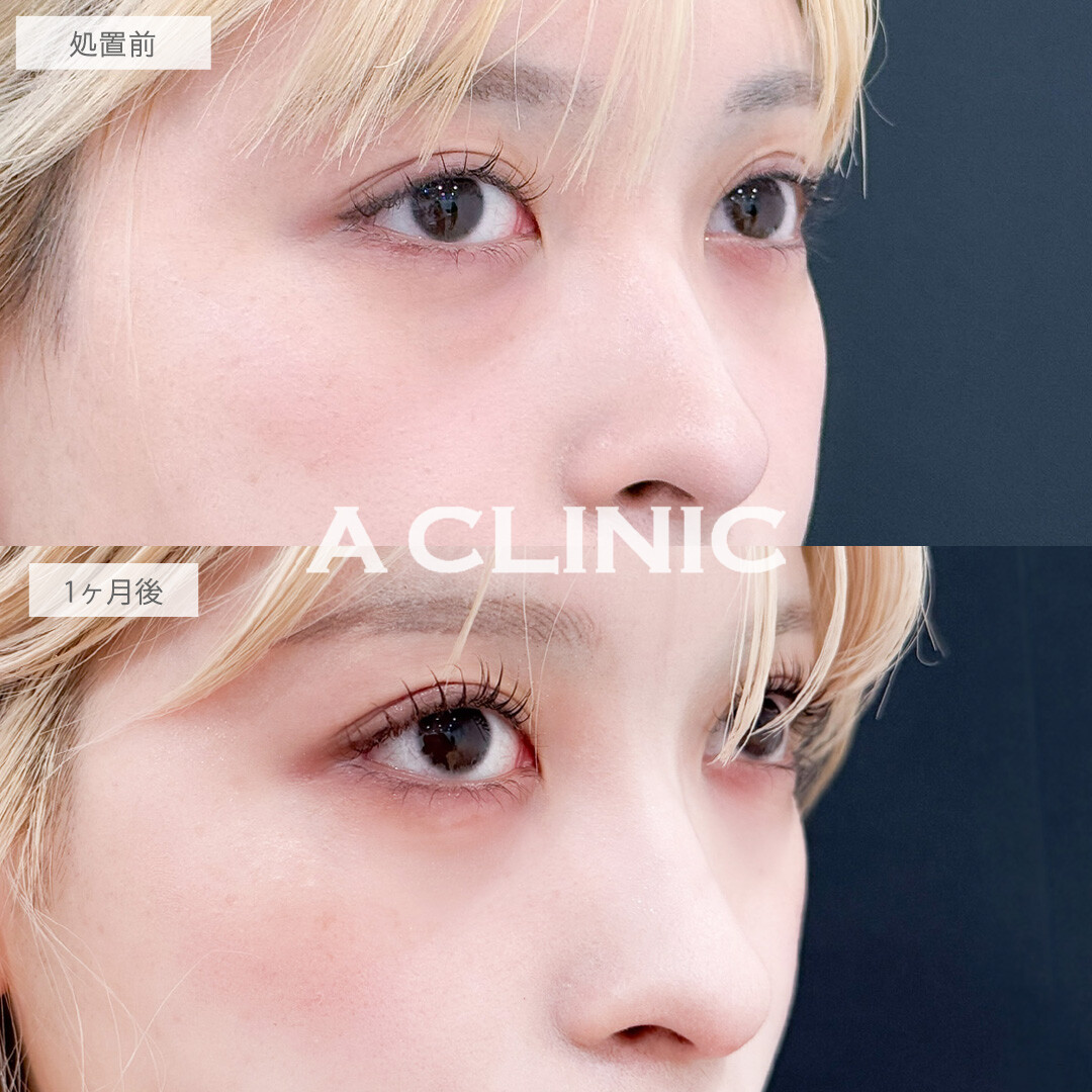 目の下のクマ取りで目元の影がなくなって一気に明るい印象に！こちら処置前と1か月後の症例です(20代女性)