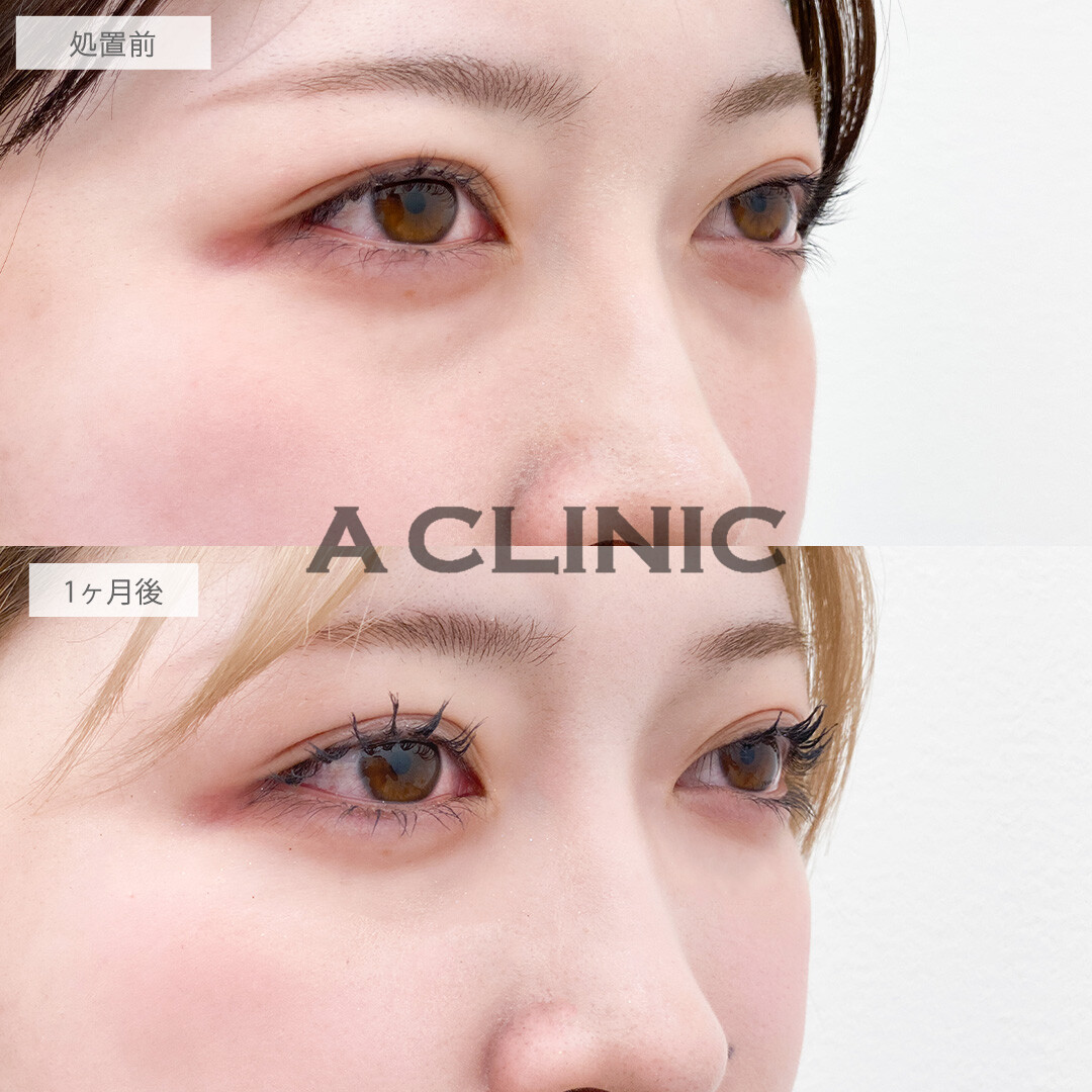 目の下のクマ取りで気になる黒クマをメイクで隠さなくてよくなります！こちら処置前と1ヶ月後の症例です(10代女性)