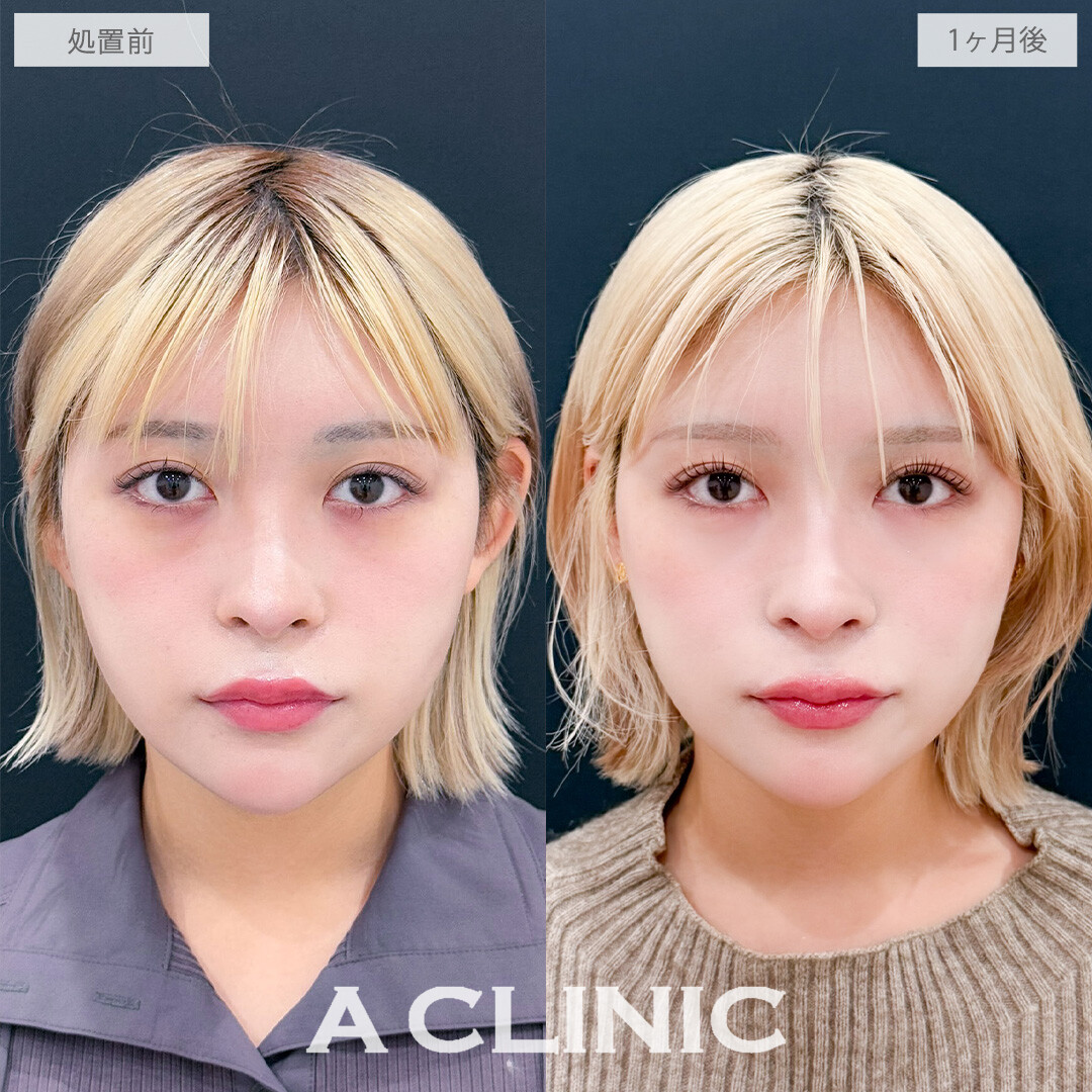 目の下のクマ取りで目元の影がなくなって一気に明るい印象に！こちら処置前と1か月後の症例です(20代女性)