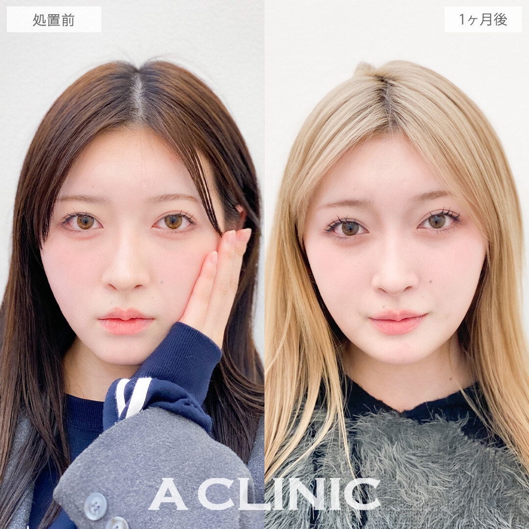 目の下のクマ取りで気になる黒クマをメイクで隠さなくてよくなります！こちら処置前と1ヶ月後の症例です(10代女性)