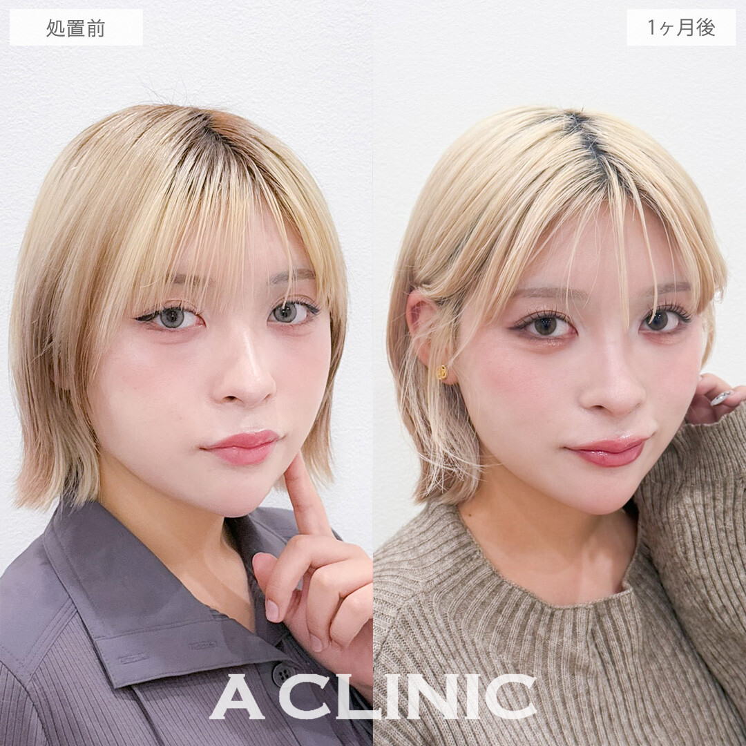 目の下のクマ取りで目元の影がなくなって一気に明るい印象に！こちら処置前と1か月後の症例です(20代女性)