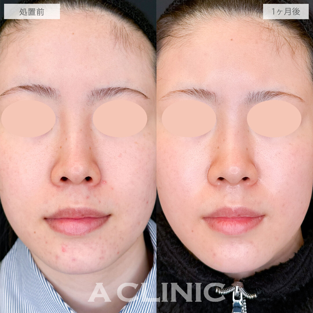 ララドクターとポテンツァでニキビ跡も薄くなり透明感をUPさせました！こちら処置前と1か月後の症例です(20代女性)