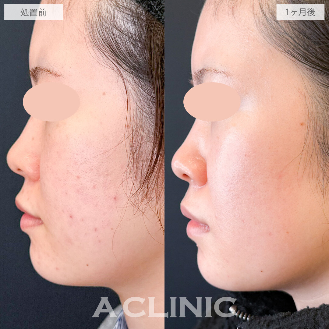 ララドクターとポテンツァでニキビ跡も薄くなり透明感をUPさせました！こちら処置前と1か月後の症例です(20代女性)