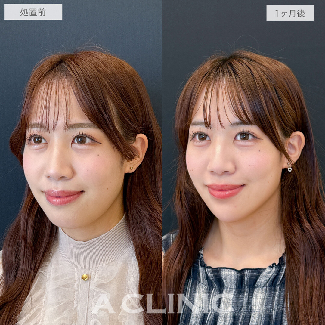 1day小顔脂肪吸引と小顔エラボトックスとあごへのヒアルロン酸注入とボトックス注射(しわ)で加工いらずの憧れていた輪郭へ！処置前と1ヶ月後の症例です(20代女性)