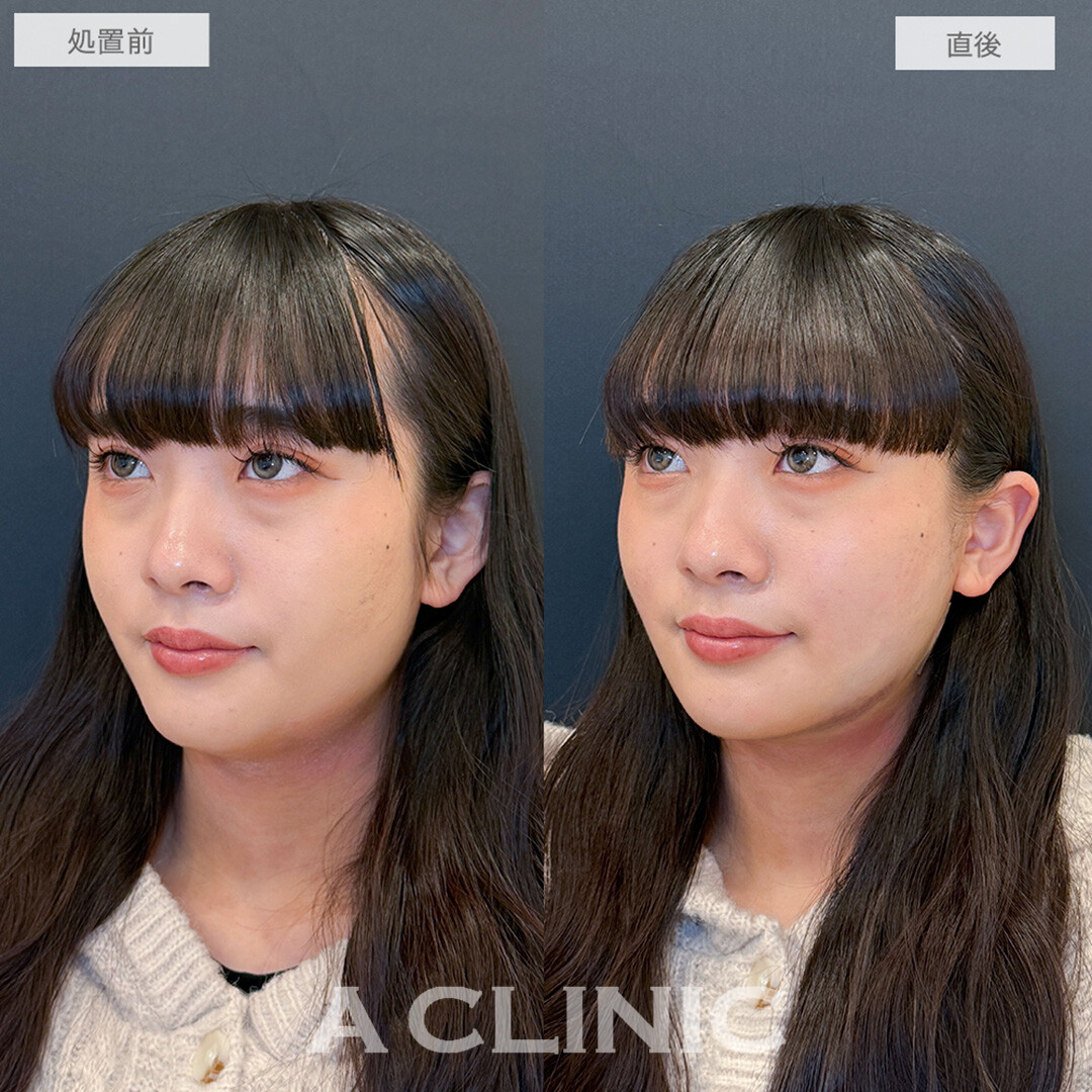 1day小顔脂肪吸引で直後から別人級のフェイスラインが誕生しました！処置前と直後の症例です(20代女性)