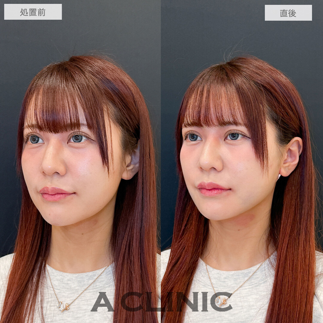 1day小顔脂肪吸引で直後からフェイスラインのもたつきが解消されました！処置前と直後の症例です(30代女性)