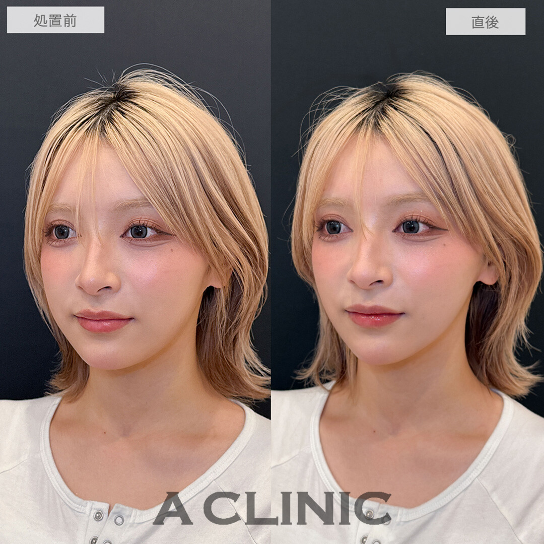 Aスレッドで輪郭が整い可愛さアップデート！処置前と直後の症例です(20代女性)