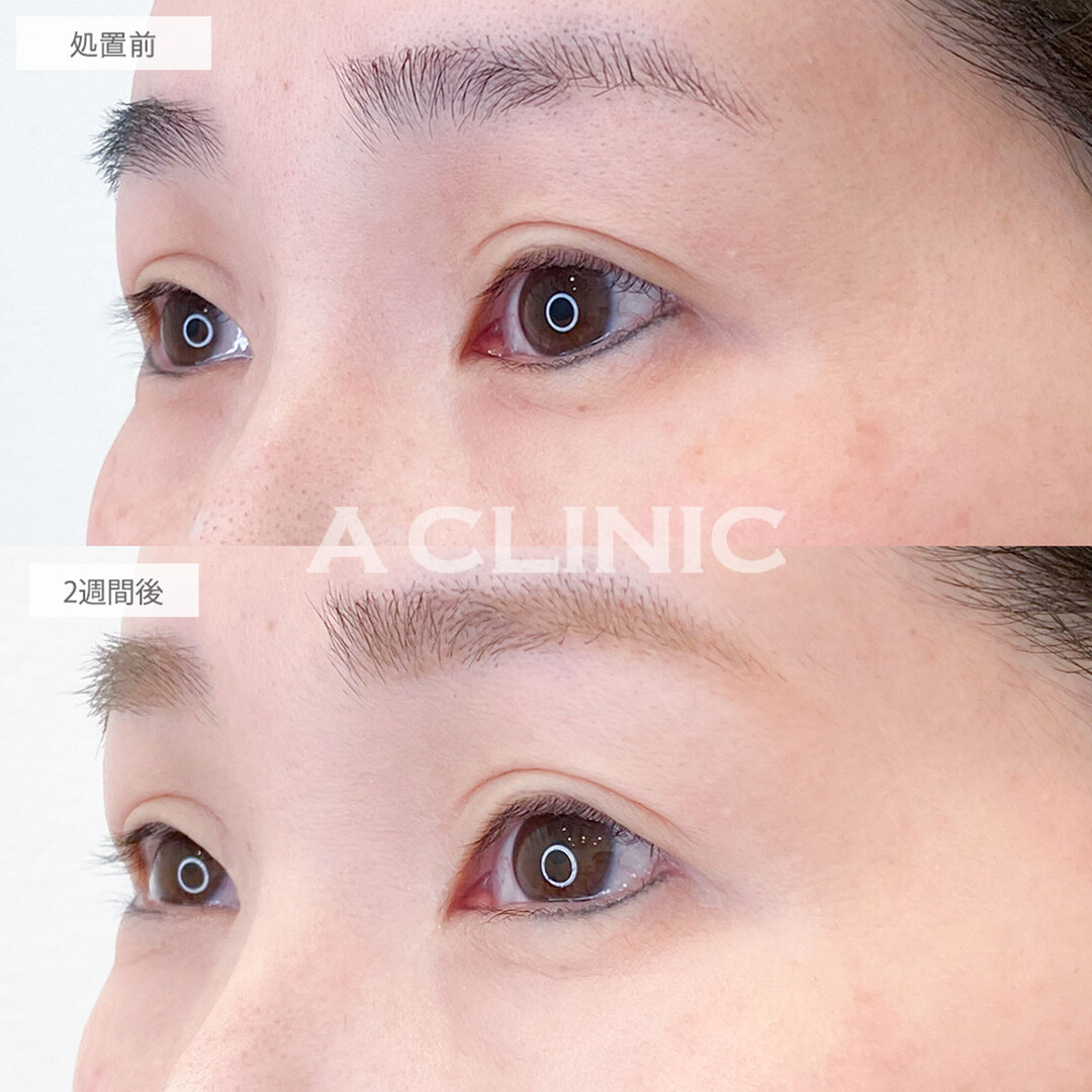 パーフェクトアイズでつり目が解消され優しく若返った印象に！処置前と2週間後の症例です(40代女性)