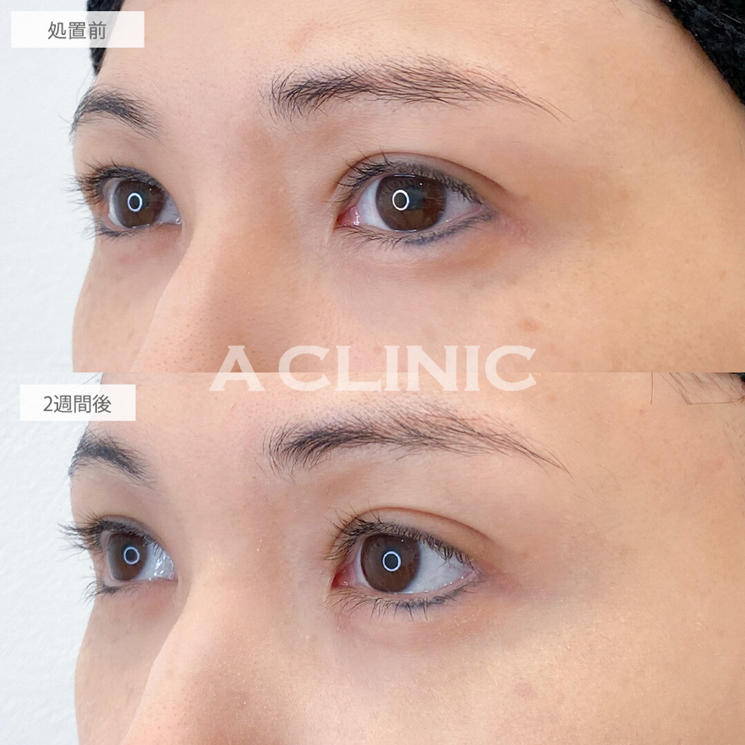 パーフェクトアイズでつり目からナチュラルなたれ目になり優しく若々しい印象に！処置前と2週間後の症例です(30代女性)