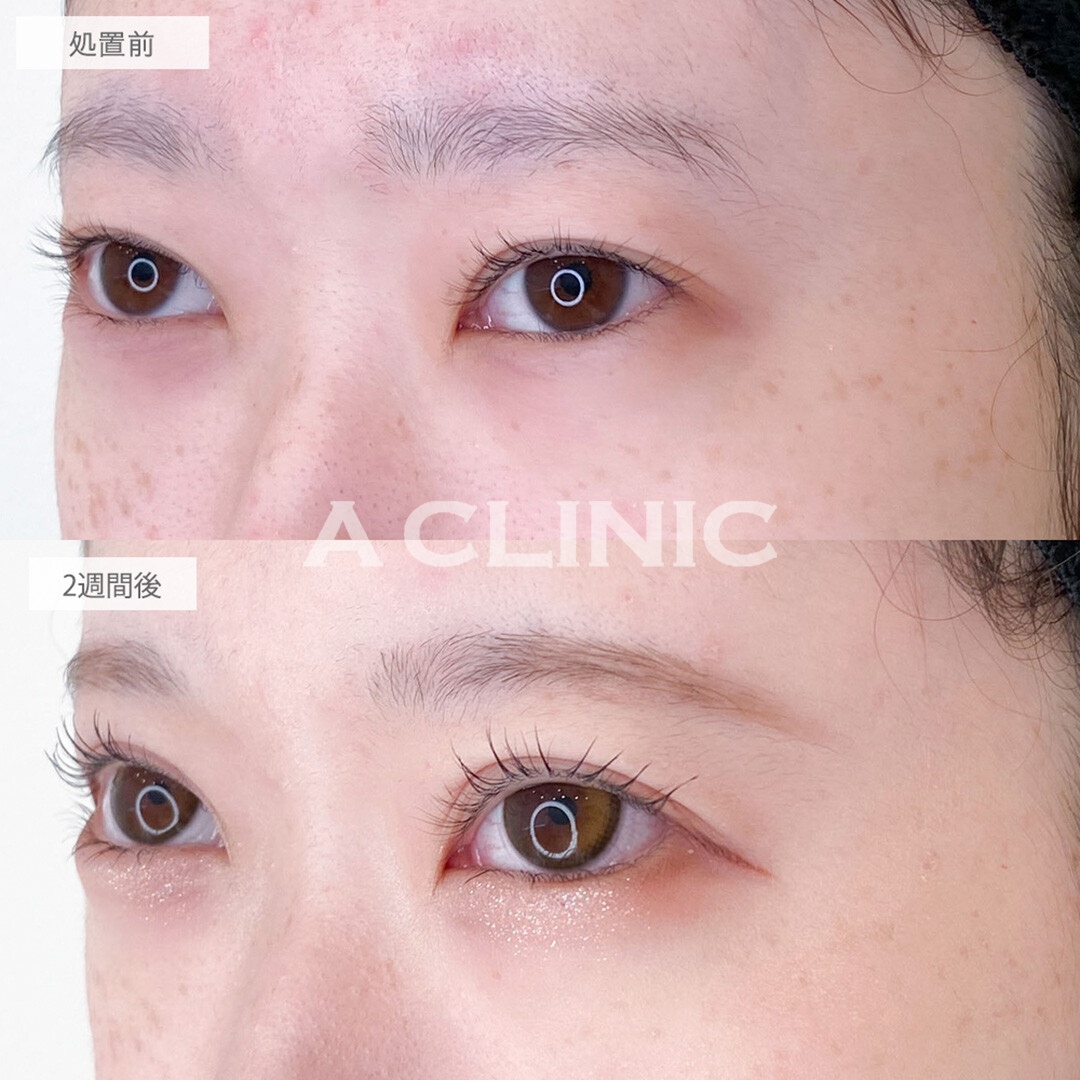 パーフェクトアイズと二重術埋没法で左右差が整い華やかなお目元に大変身！処置前と2週間後の症例です(20代女性)