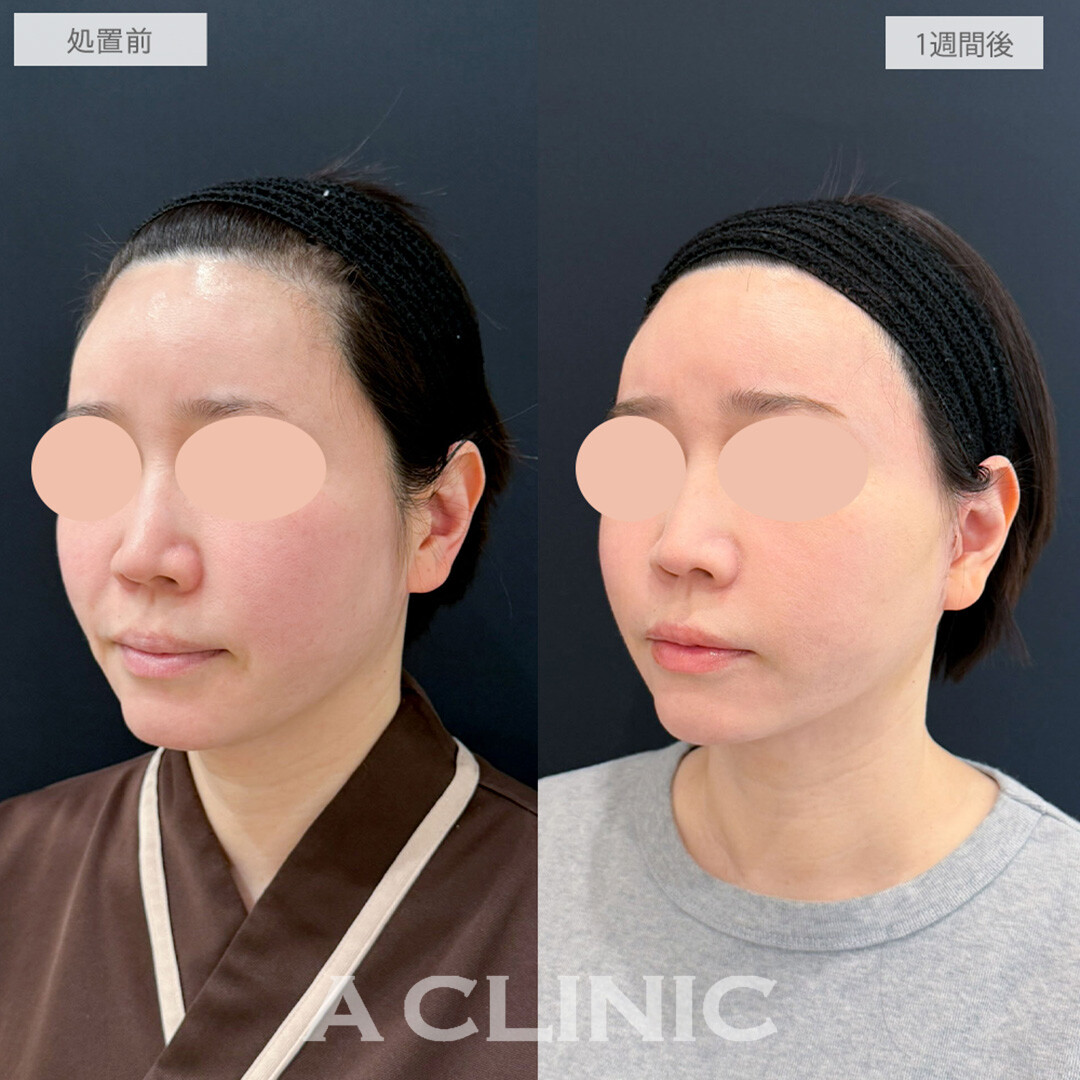 【直後の傷跡あり】A式美肌たるみ切開と小顔エラボトックスとヒアルロン酸注射(シワ)でほうれい線がなくなり若返り成功！処置前と1週間後の症例です(40代女性)
