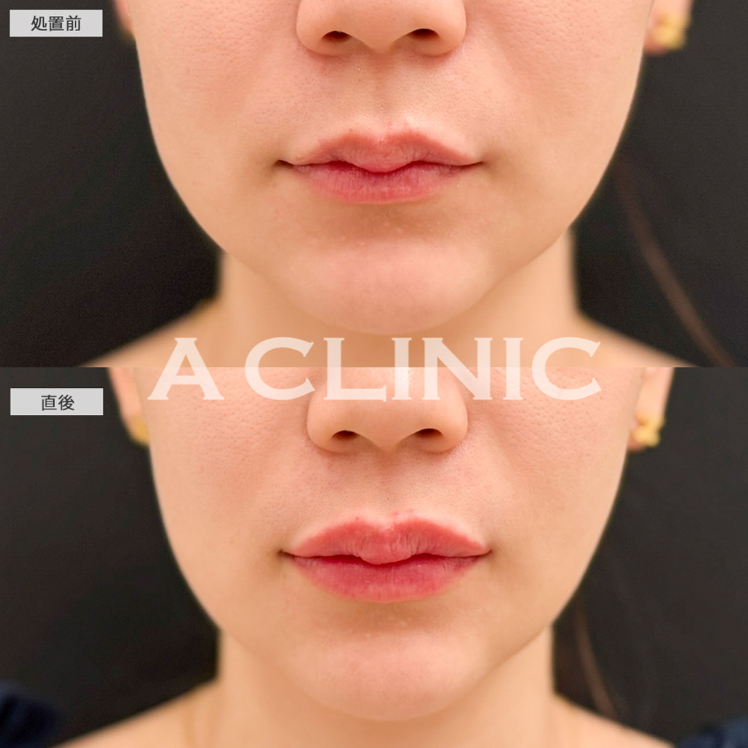 リップヒアルロン酸注入で唇のボリュームアップし人中も短くなりました！こちら処置前と直後の症例です(20代女性)