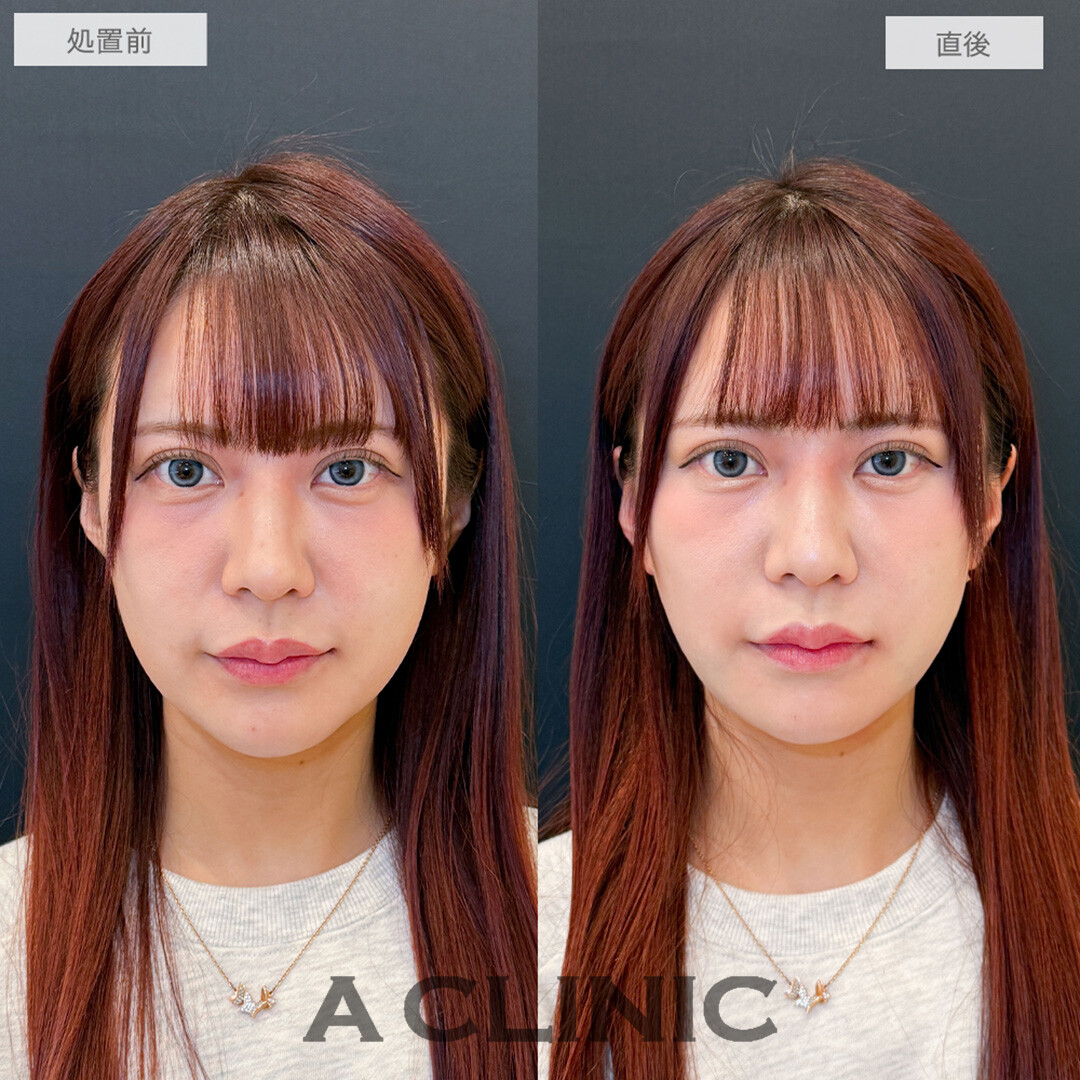 1day小顔脂肪吸引で直後からフェイスラインのもたつきが解消されました！処置前と直後の症例です(30代女性)