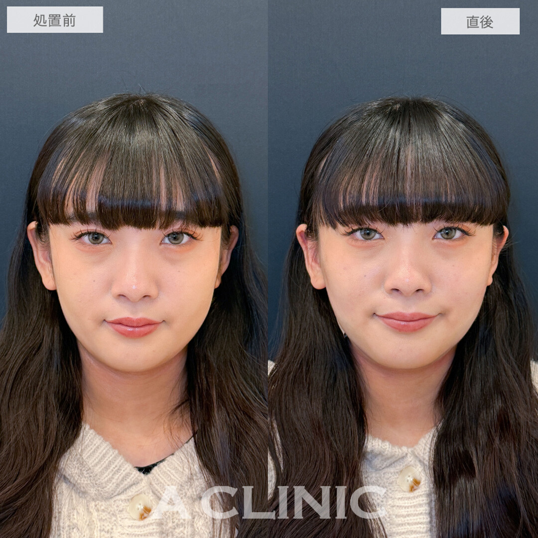 1day小顔脂肪吸引で直後から別人級のフェイスラインが誕生しました！処置前と直後の症例です(20代女性)