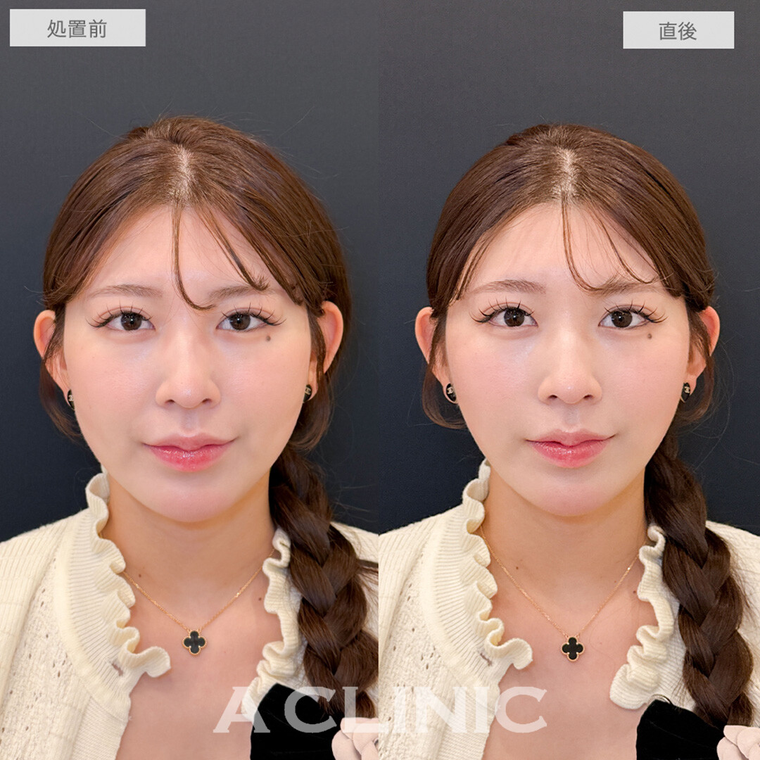 Aスレッドで即日自分に合った小顔が手に入りました！処置前と直後の症例です(20代女性)