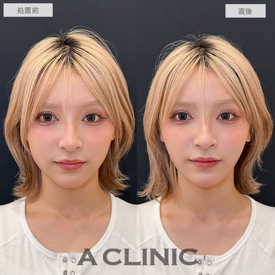 Aスレッドで輪郭が整い可愛さアップデート！処置前と直後の症例です(20代女性)