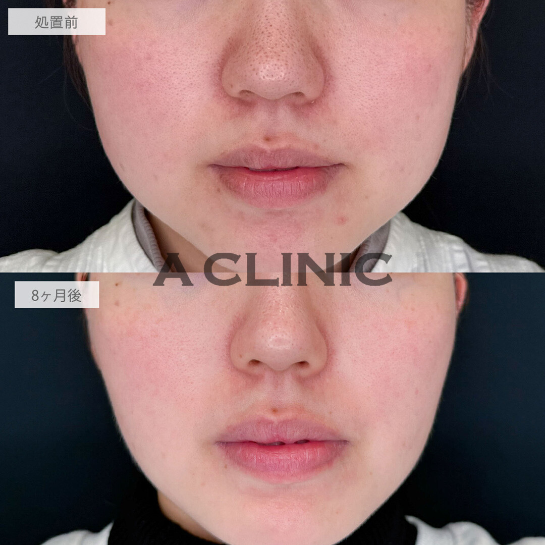 ポテンツァとイソトレチノインとクールビタミントリートメントとケミカルピーリングで毛穴が改善されお肌の土台が整いました！処置前と8ヶ月後の症例です(20代女性)