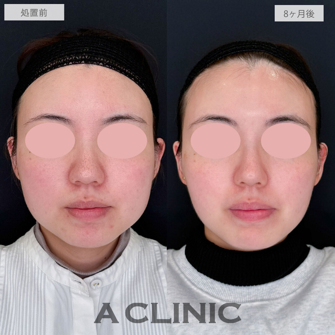 ポテンツァとイソトレチノインとクールビタミントリートメントとケミカルピーリングで毛穴が改善されお肌の土台が整いました！処置前と8ヶ月後の症例です(20代女性)
