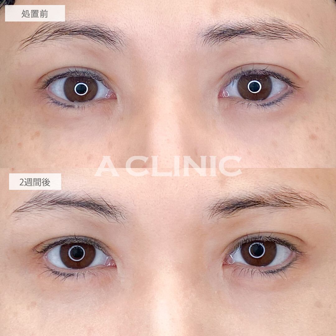 パーフェクトアイズでつり目からナチュラルなたれ目になり優しく若々しい印象に！処置前と2週間後の症例です(30代女性)