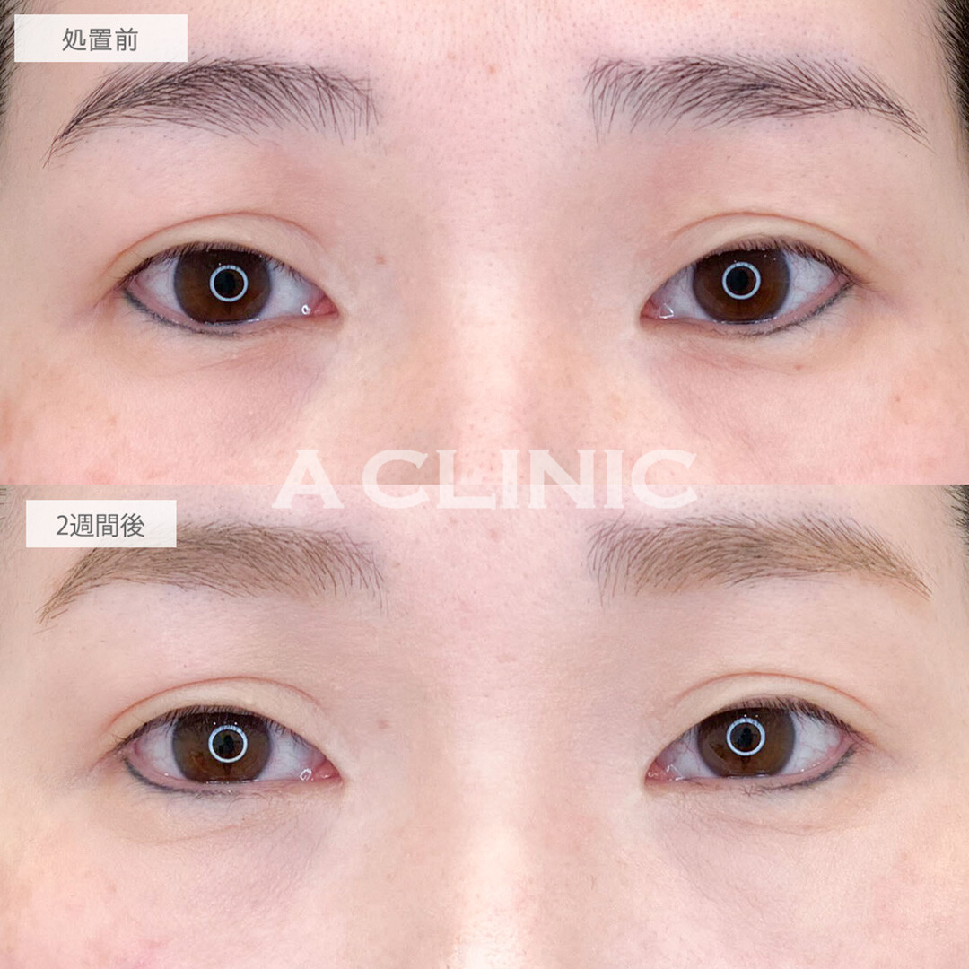 パーフェクトアイズでつり目が解消され優しく若返った印象に！処置前と2週間後の症例です(40代女性)