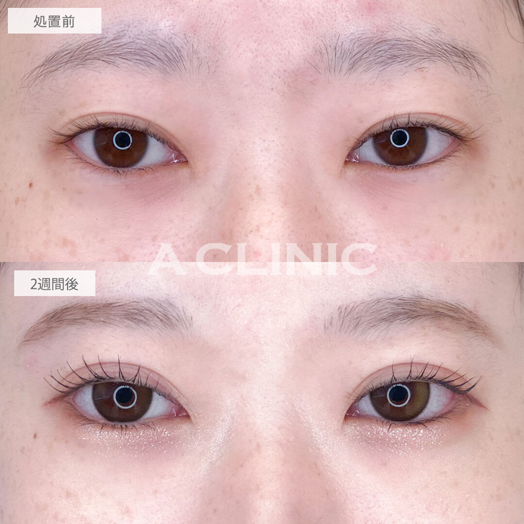 パーフェクトアイズと二重術埋没法で左右差が整い華やかなお目元に大変身！処置前と2週間後の症例です(20代女性)