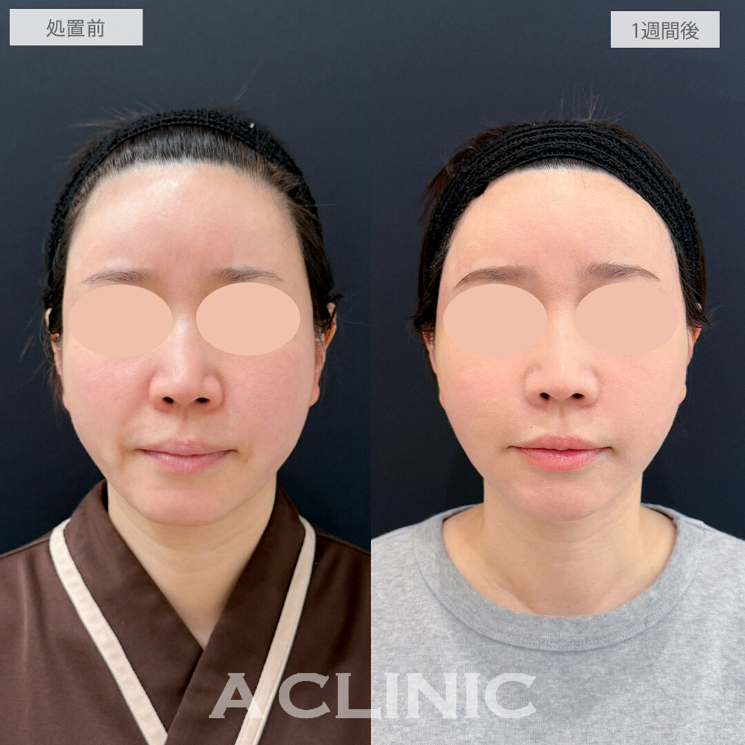 【直後の傷跡あり】A式美肌たるみ切開と小顔エラボトックスとヒアルロン酸注射(シワ)でほうれい線がなくなり若返り成功！処置前と1週間後の症例です(40代女性)