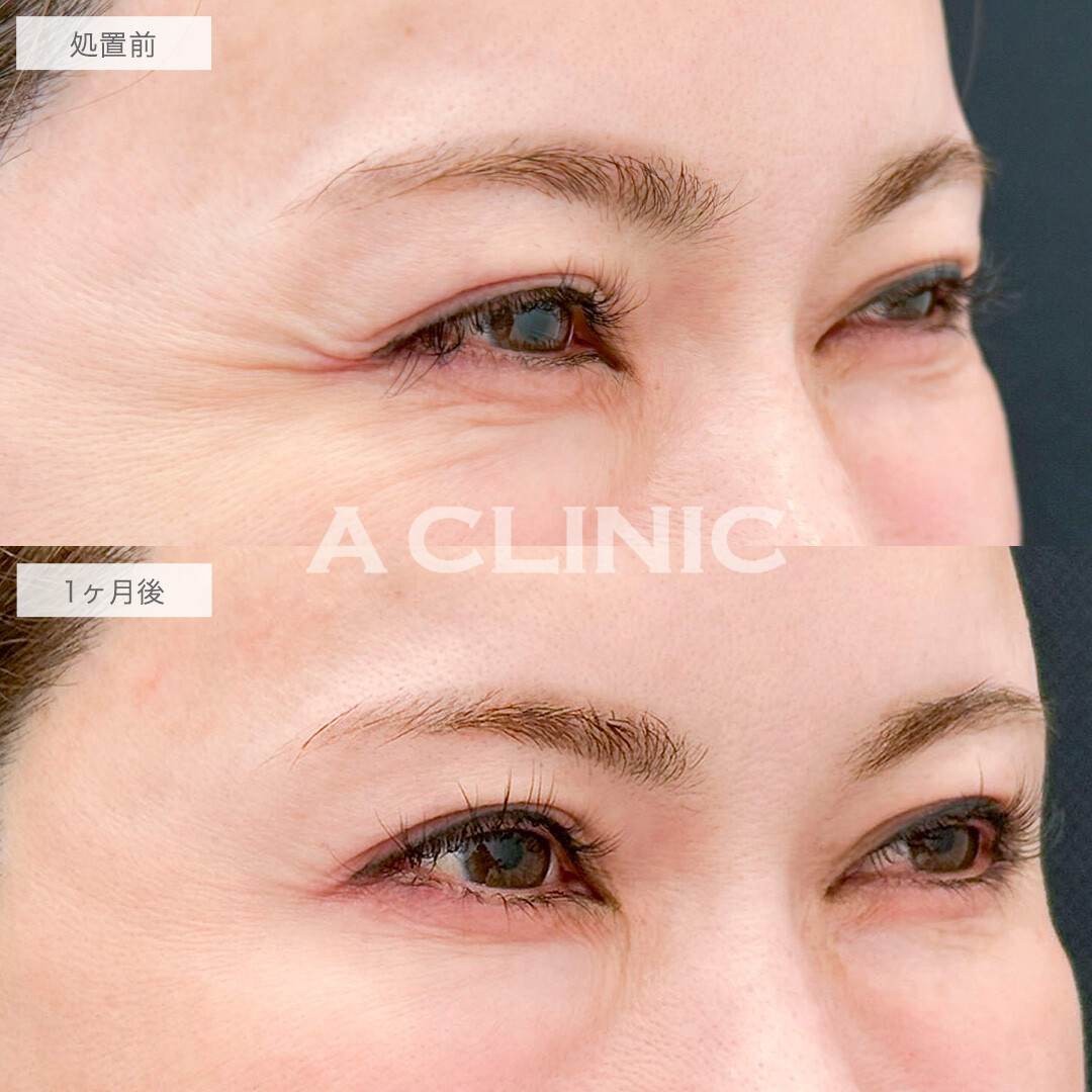 ボトックス注射(しわ)で笑った時にできる目尻のしわが軽減されました！処置前と1ヶ月後の症例です(40代女性)