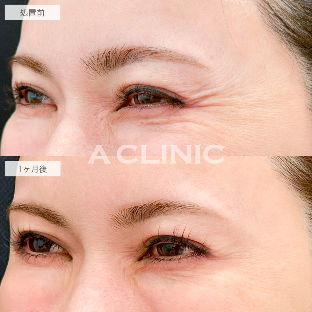 ボトックス注射(しわ)で笑った時にできる目尻のしわが軽減されました！処置前と1ヶ月後の症例です(40代女性)