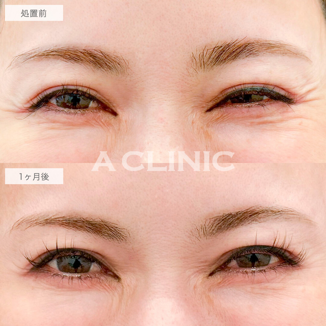 ボトックス注射(しわ)で笑った時にできる目尻のしわが軽減されました！処置前と1ヶ月後の症例です(40代女性)