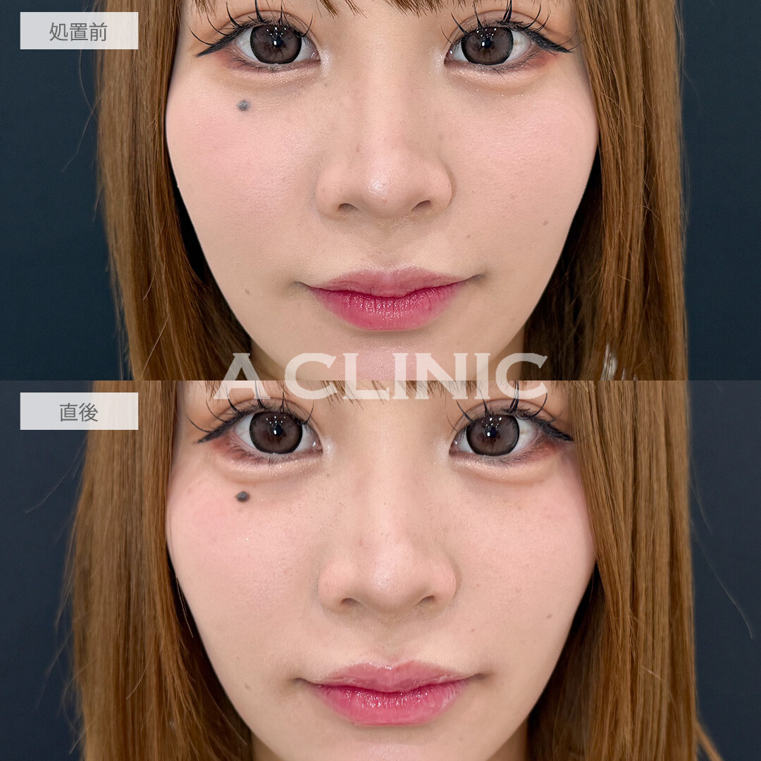 涙袋形成術(ヒアルロン酸)とリップヒアルロン酸注入で自然にその日のうちから中顔面短縮！こちら処置前と直後の症例です(20代女性)