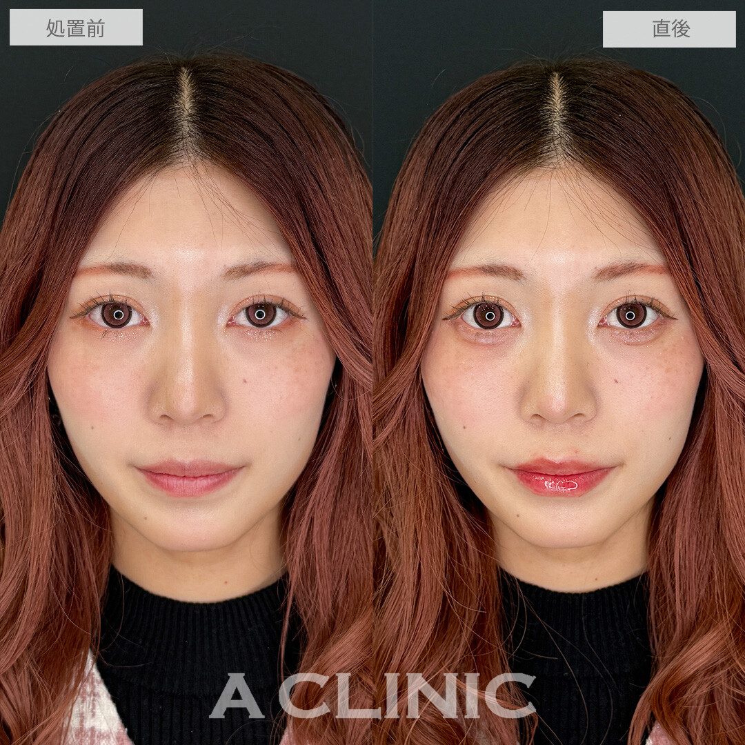 涙袋形成術(ヒアルロン酸)とリップヒアルロン酸注入で即日手軽に中顔面短縮！こちら処置前と直後の症例です(20代女性)