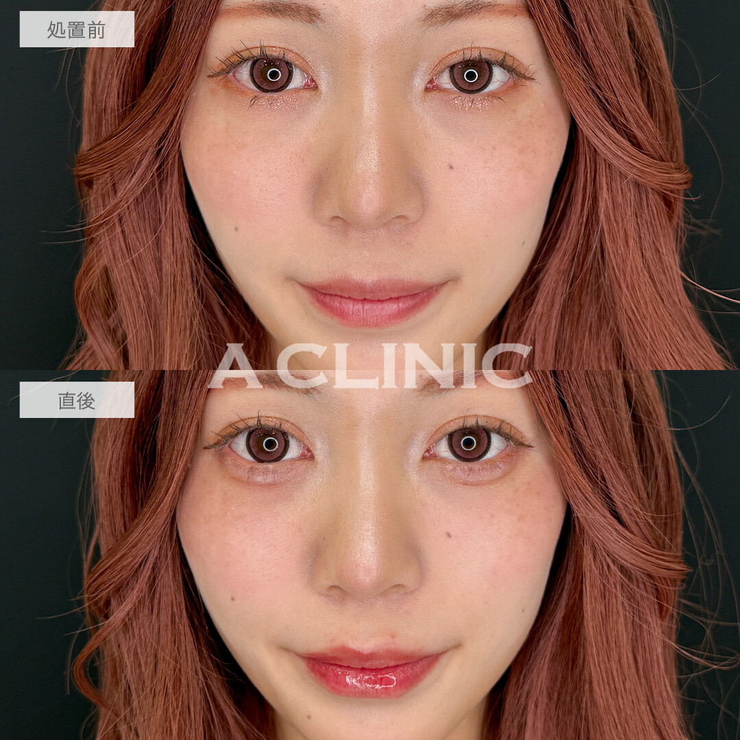 涙袋形成術(ヒアルロン酸)とリップヒアルロン酸注入で即日手軽に中顔面短縮！こちら処置前と直後の症例です(20代女性)