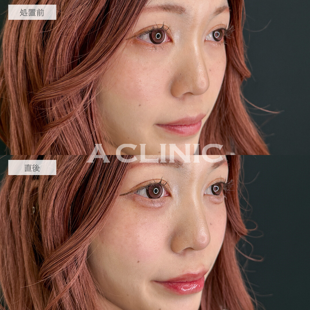 涙袋形成術(ヒアルロン酸)とリップヒアルロン酸注入で即日手軽に中顔面短縮！こちら処置前と直後の症例です(20代女性)