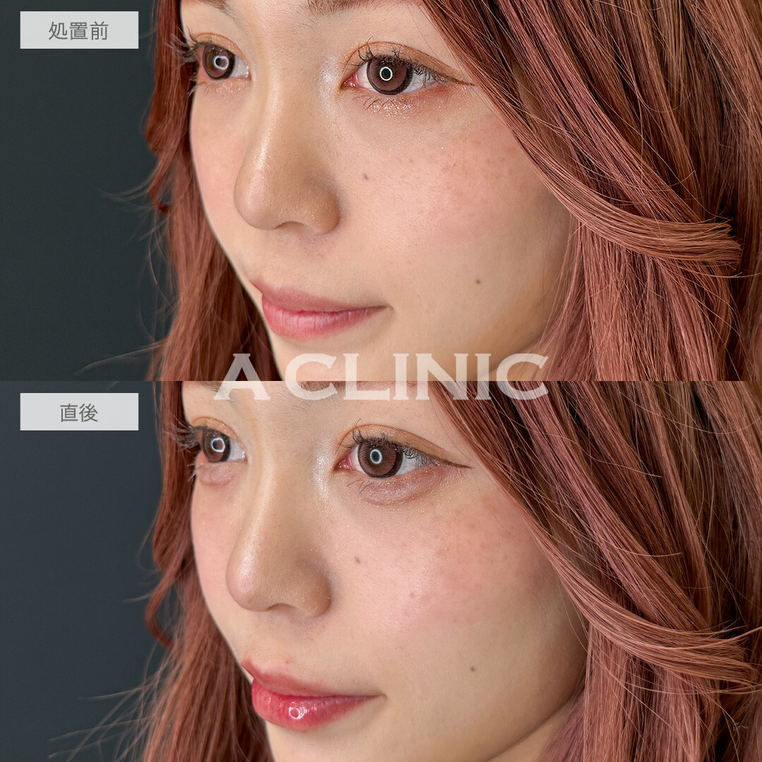 涙袋形成術(ヒアルロン酸)とリップヒアルロン酸注入で即日手軽に中顔面短縮！こちら処置前と直後の症例です(20代女性)