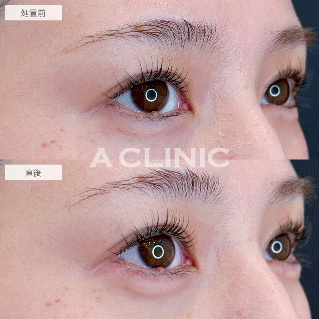 涙袋形成術(ヒアルロン酸)でメイク無しでもぷっくり可愛い涙袋に！処置前と直後の症例です(30代女性)